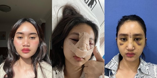 Previously Swollen and Bruised, Here are 8 Photos of Permesta Dhyaz, Farida Nurhan's Daughter, Before and After Rhinoplasty - Making Netizens Obsessed