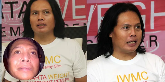 Seperti Rano Karno, Ageng Kiwi Juga Kena Penyakit Bell’s Palsy