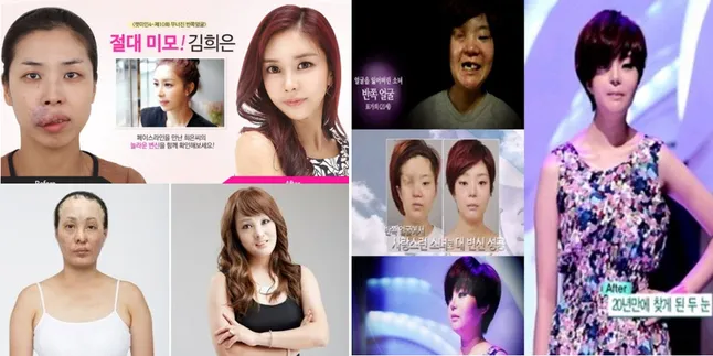 Sisi Lain Operasi Plastik Korea, Inspiratif?