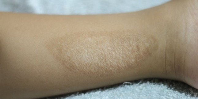 To Return Smooth, Here are 7 Ways to Naturally Remove Exhaust Burn Scars