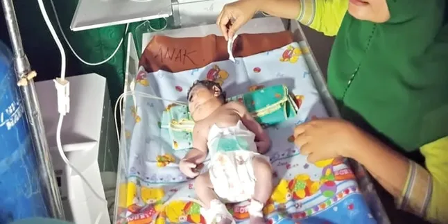 Tak Mampu Bertahan, Bayi Bermata Satu Meninggal Dunia Setelah Dirawat Selama 7 Jam