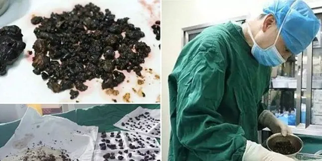 Tak Pernah Sarapan, Ginjal Wanita Ini Dipenuhi 200 Batu!