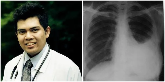 Tak Sadar Terserang Penyakit Paru-Paru, Pria Perokok Ini Meninggal