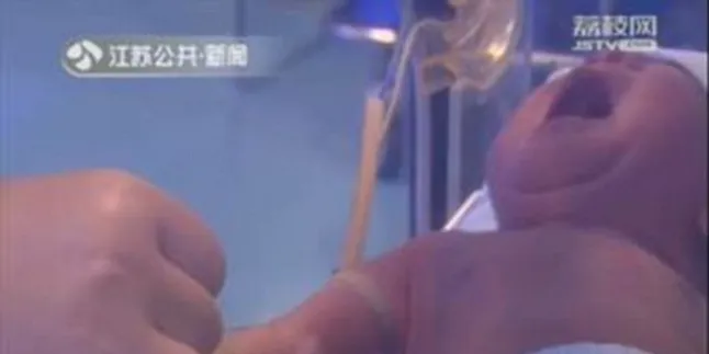 Tak Sengaja Terbelit Sehelai Rambut, Jari Bayi Ini Hampir Putus