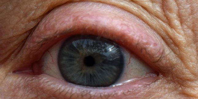 Signs of High Cholesterol in the Eyes and Its Impact, Beware Before It Gets Worse