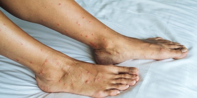 Cause Red Spots - Appear Lumps, Here Are 6 Ways to Remove Mosquito Bite Marks