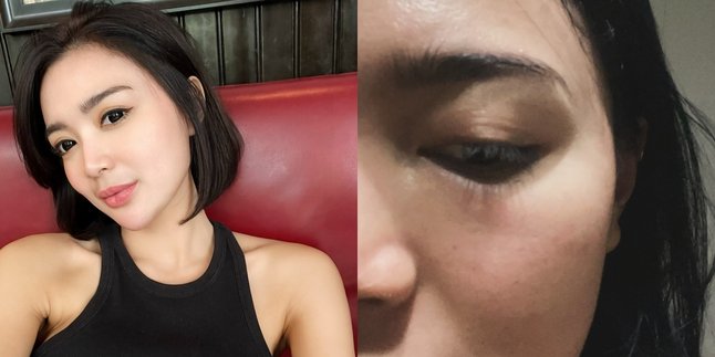 Wika Salim Tells About Her Condition That Suddenly Made Her Shiver Until One Eye Swelled Up