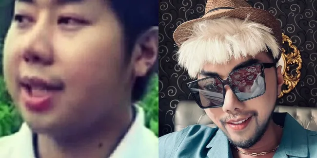 13 Transformasi Artis yang Lakukan Treatment Dagu Lancip, Before Afternya Bikin Kaget