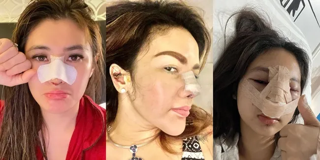 Blak-Blakan! Sederet Seleb Ini Jalani Operasi Plastik Hidung dengan Harga Fantastis, Makin Percaya Diri - Potretnya Kini Curi Perhatian