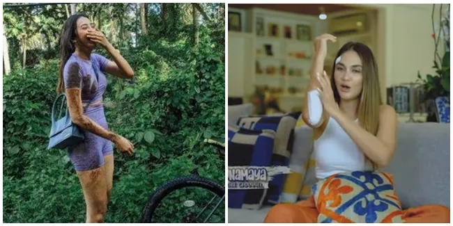 6 Selebriti Ini Pernah Terlibat Kecelakaan Sepeda & Motor, Ada yang Dahinya Sampai Sobek!