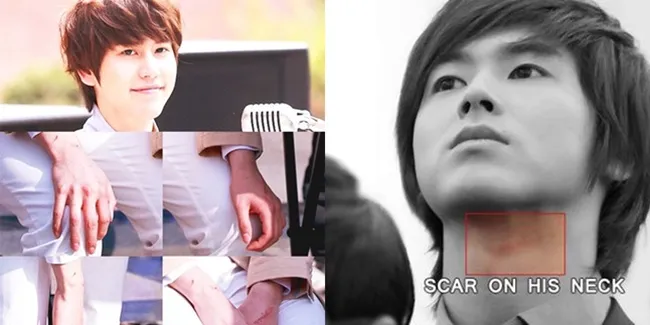 Kisah Pilu di Balik Bekas Luka Para Bintang K-Pop