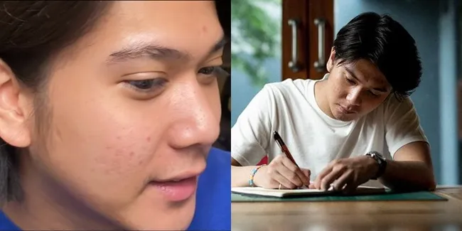 Potret Iqbaal Ramadhan Jalani Perawatan Kulit di Klinik Milik Tompi, Sudah Mulai Membaik