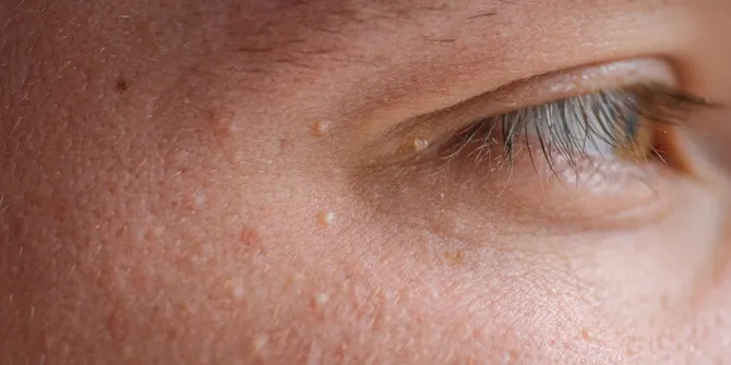 Penyebab Milia yang Dapat Dihindari, Kunci untuk Kulit Sehat dan Bersinar!