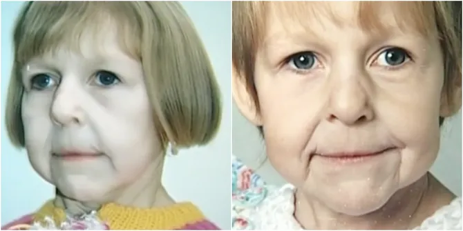 Alami Kondisi Mirip Benjamin Button, Wanita Ini Ditinggalkan Ayah