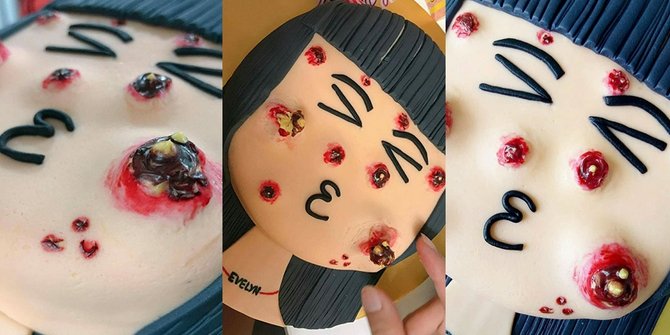 Cake Unik Berhiaskan 'Jerawat' yang Bisa Dipencet, Mau Coba?