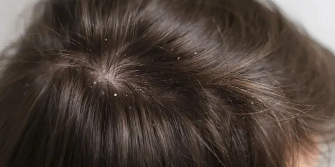 Cara Ampuh Mengatasi Ketombe Kering, Manfaat Rosemary dan Cuka Sari Apel