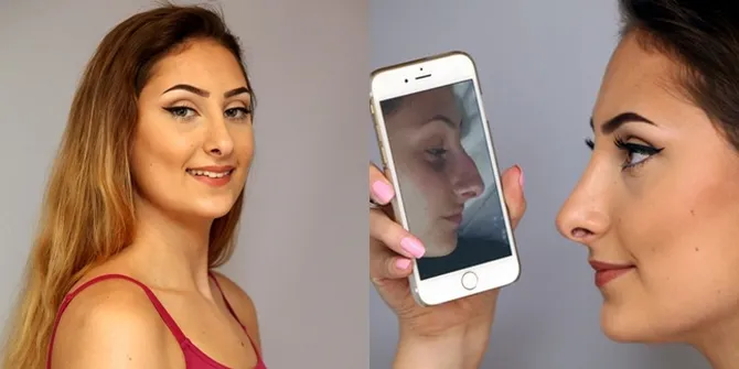 Rela Sakit Saat Oplas, Cewek Ini Ubah Hidung Demi Karier 