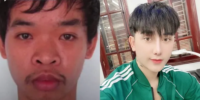 Berubah Drastis, Ini 8 Potret Do Quyen Pria Vietnam yang Oplas Usai Ditertawakan Saat Wawancara Kerja