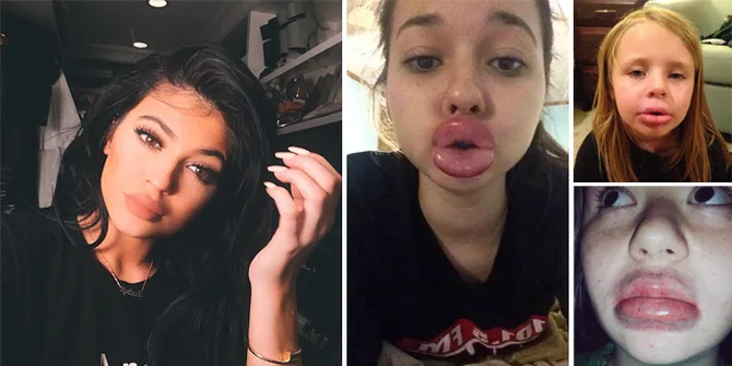 Bikin Ngakak! Gara-Gara Kylie Jenner, Mereka Jadi 'Monster Bibir'