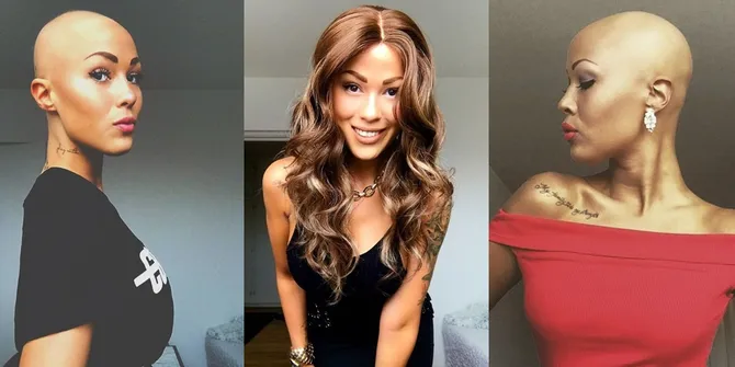 Derita Alopecia, Wanita Ini Justru Dapat Kontrak Sebagai Model