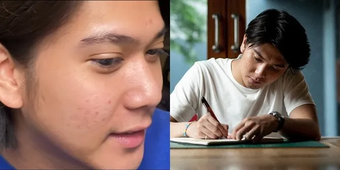 Potret Iqbaal Ramadhan Jalani Perawatan Kulit di Klinik Milik Tompi, Sudah Mulai Membaik