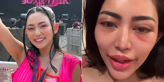 Potret Mata Rachel Vennya Bengkak Usai Oplas Sedot Lemak di Pipi, Wajah Tirusnya Dicap Makin Aneh Oleh Netizen