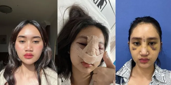 Sempat Lebam dan Bengkak di Wajah, Ini 8 Potret Permesta Dhyaz Anak Farida Nurhan Sebelum dan Sesudah Oplas Hidung di Thailand - Netizen Salfok Abis!