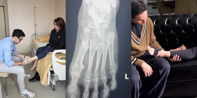 Ussy Sulistiawaty Gagal Marathon Karena Kaki kejatuhan Botol Minum, Harus Istirahat 8 Minggu