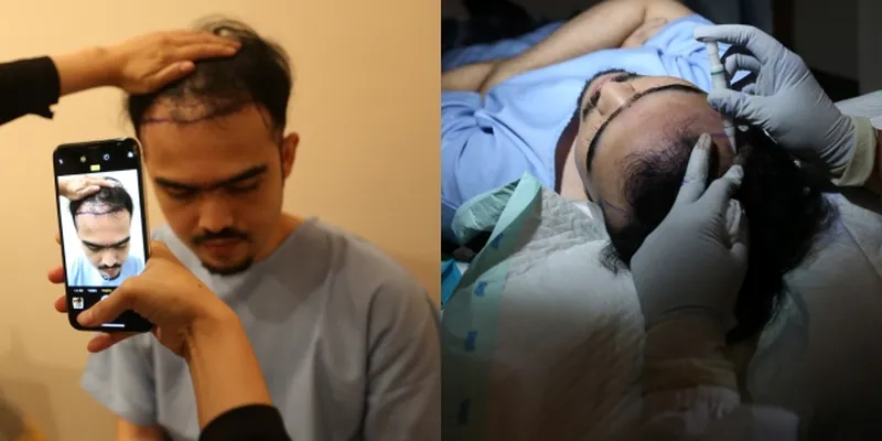 Mengintip Proses Hair Transplantation di Kai Aesthetic Clinic, Pakai Teknik Baru dengan Tingkat Keberhasilan 98%
