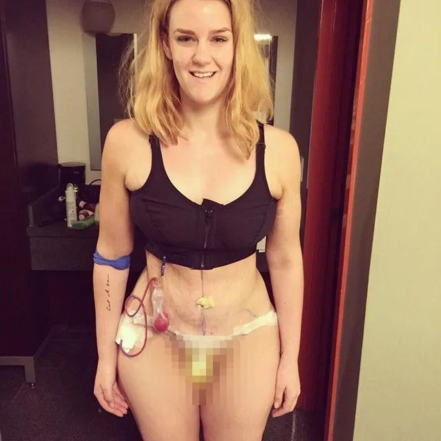 Pasca operasi plastik | copyright Instagram/simone_anderson