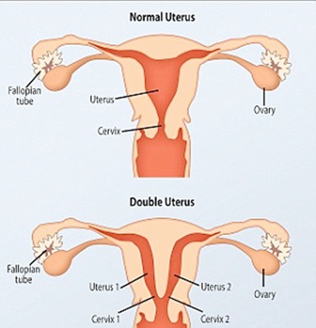 Perbandingan rahim normal dan rahim ganda | foto: copyright dailymail.co.uk