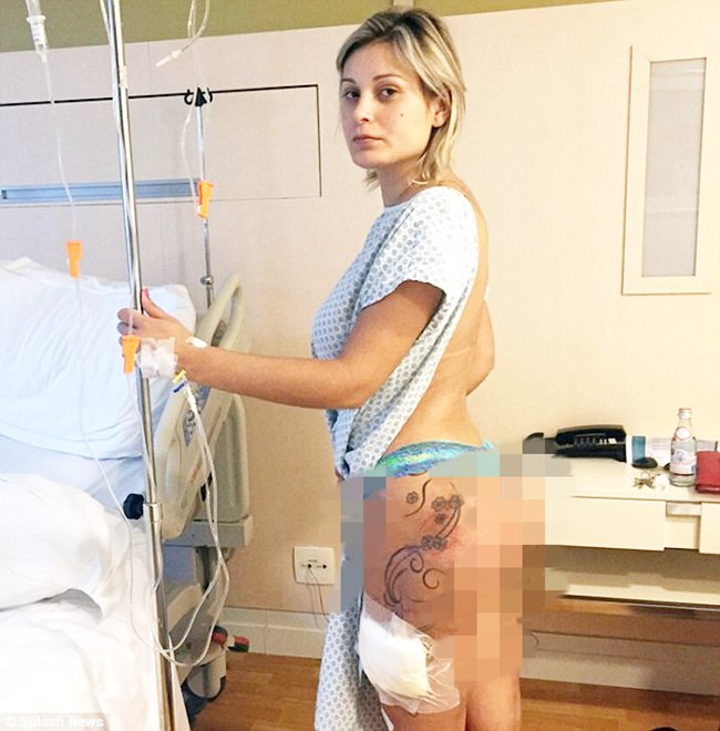 Bokong, Andressa mengalami infeksi karena pembusukan implan | foto: copyright dailymail.co.uk