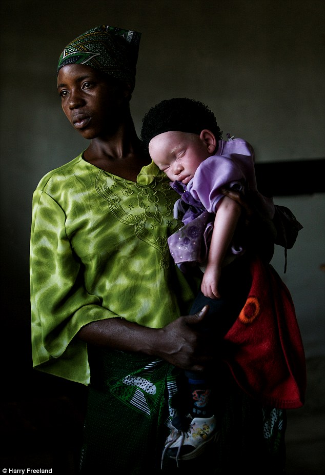 Anak Albino bersama sang ibu di Tanzania | Photo: Copyright daylimail.co.uk