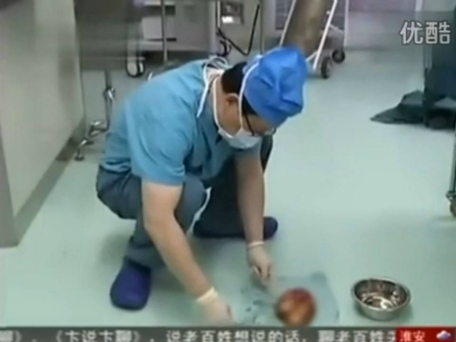 Tim dokter telah menemukan janin yang berubah menjadi tumor ganas sepanjang 16 cm di perut bayi malang tersebut | Photo: Copyright shanghaiist.com