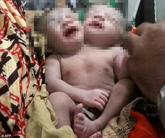 Bayi berkepala dua | Photo: Copyroght dailymail.co.uk 