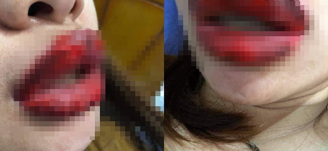 Kondisi bibir wanita yang meradang dan bengkak akibat produk kosmetik lipstik palsu/copyright viral4real.com