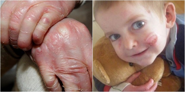 Detik-detik kulit Rhys yang mengelupas Foto Copyright Dailymail.co.uk