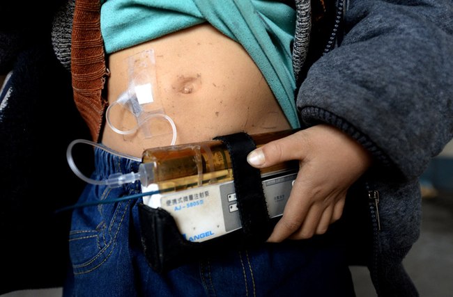 Obat untuk mengurangi kelebihan zat besi diletakkan pada alat portable yang bisa dibawa kemana-mana | foto: copyright chinadaily.com.cn