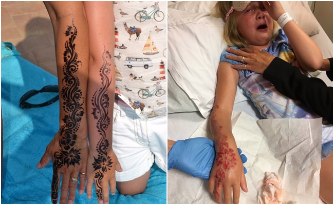 Kiri: lengan Ibu Maddison dan Maddison setelah ditato henna. Kanan: Madison di rumah sakit karena kulit lengannya melepuh./Copyright metro.co.uk