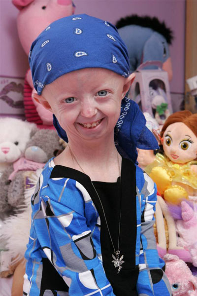Hayley mengidap penyakit langka yang bernama progeria | foto: copyright metro.co.uk