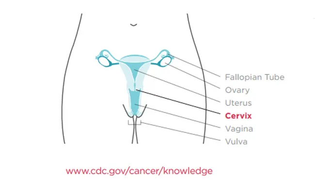 99,7% Penularan Kanker Serviks Disebabkan Oleh Hubungan Seksual