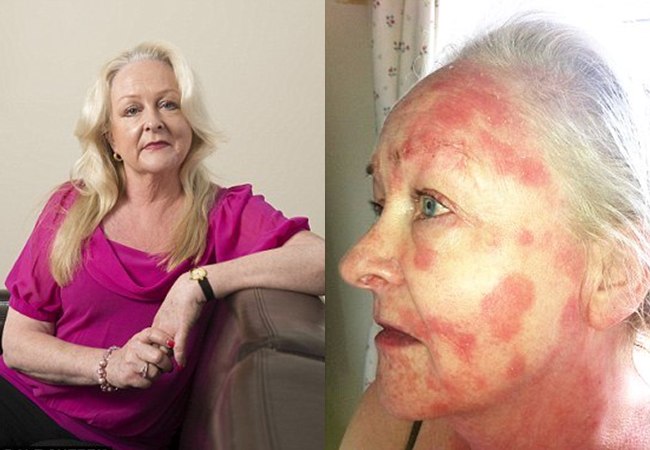 Karen Mooney, wajahnya melepuh dan luka-luka setelah memakai krim dari Clarins | foto: copyright dailymail.co.uk