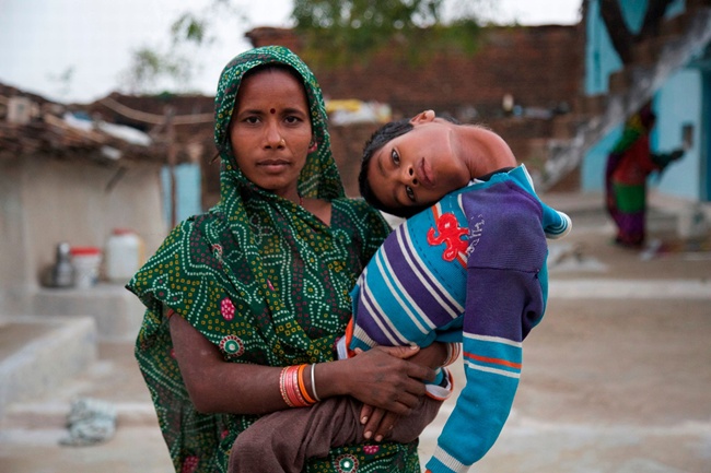 Mahendra adalah anak dengan kondisi langka yang mengakibatkan kepalanya miring | Photo: Copyright mirror.co.uk