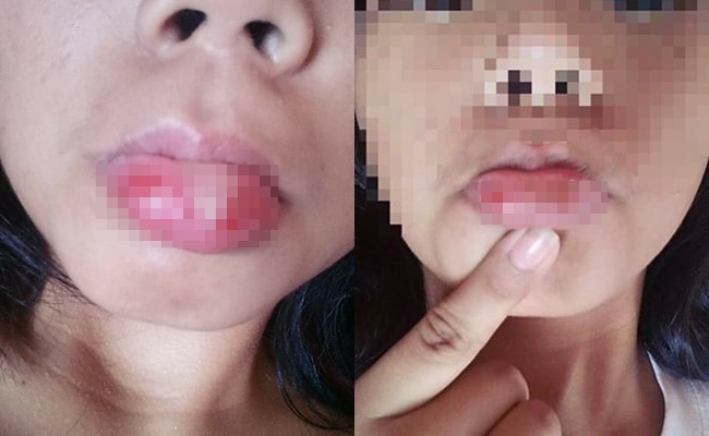 Bibir Mariah yang mengalami infeksi/copyright viral4real.com