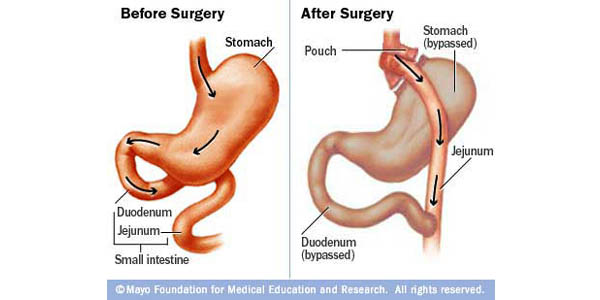 Kiri: lambung normal, kanan: hasil gastric bypass | Gambar: advancebariatric