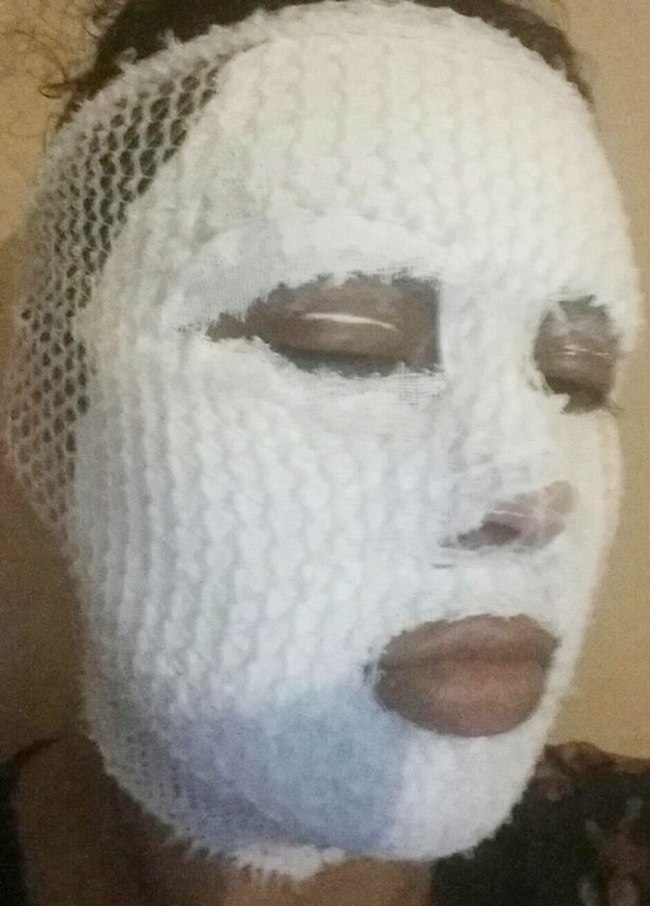 Tak tahan dengan penyakitnya, Shabana harus menutupi wajahnya dengan masker tebal | foto: copyright dailymail.co.uk