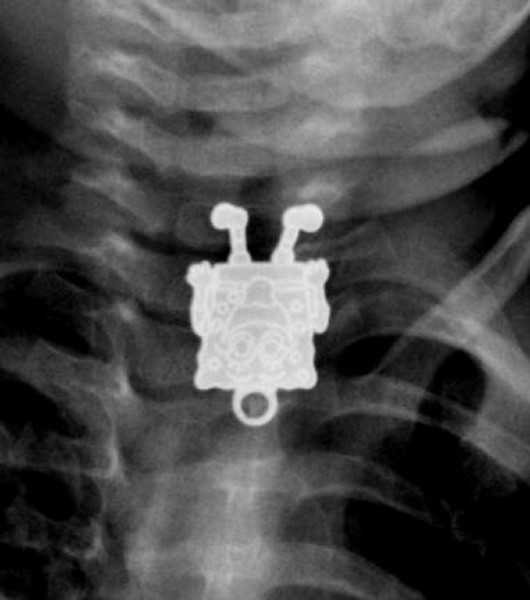 Hasil X-Ray, benda asing berupa mainan spongebob squarepants | Foto: copyright Singaporeseen.com